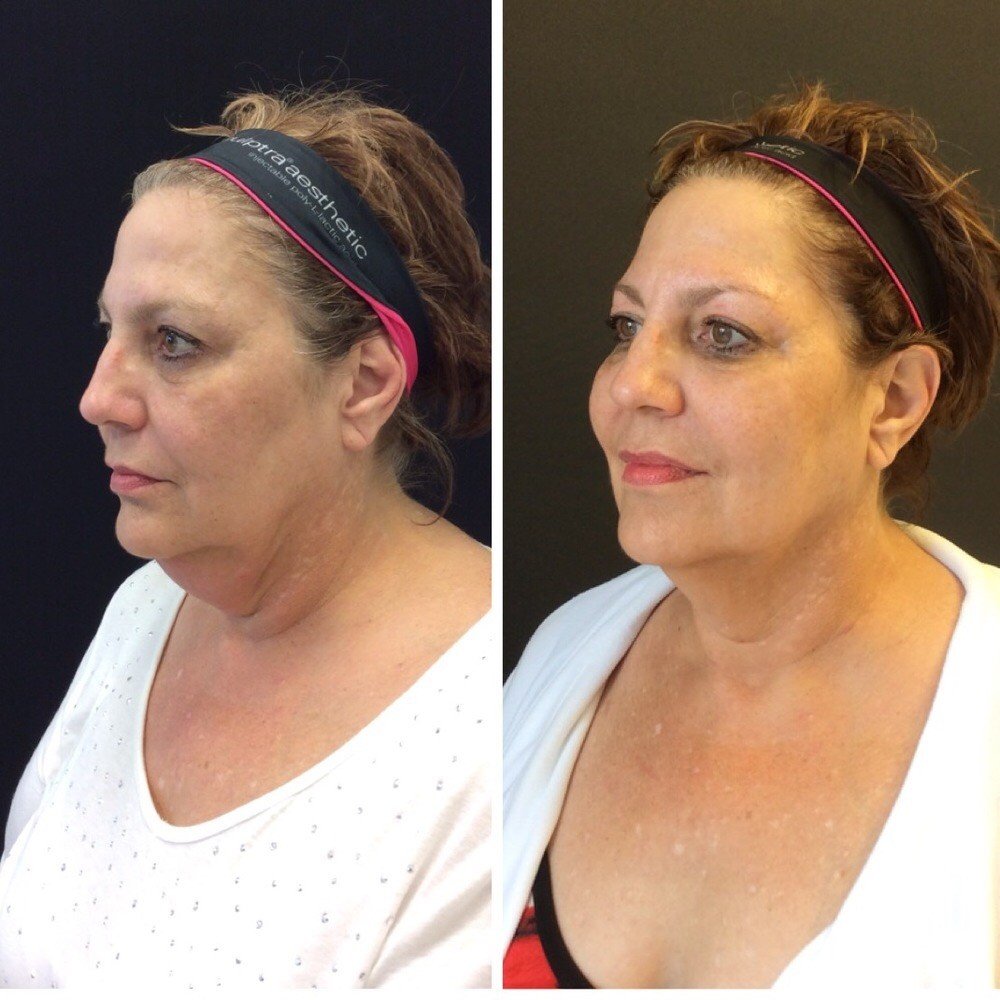 kybella-before-after-chicago