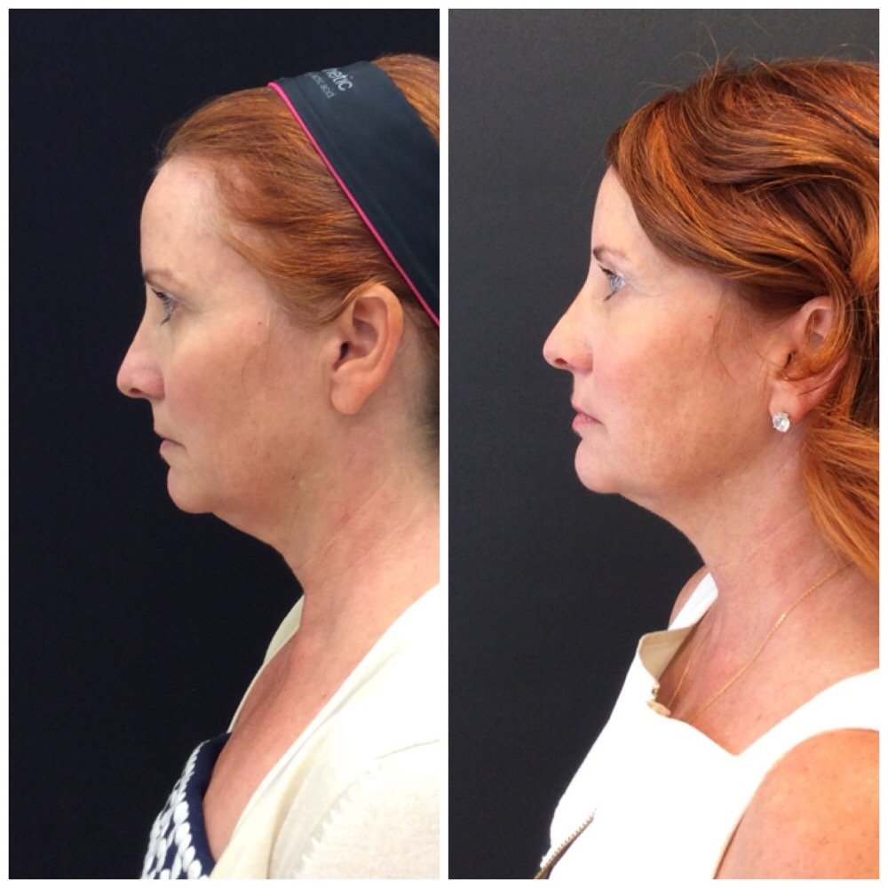 kybella-before-after