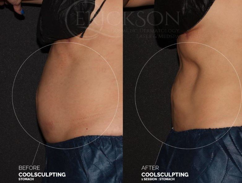 Belly Fat Removal Colorado Springs - CoolSculpting On Abdomen