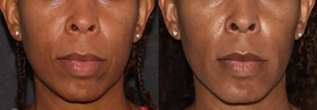 Dermal Fillers Before and After Photo by Dr. Erickson in Chicago, IL