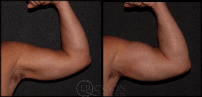Bicep Emsculpt Before and After Photo by Dr. Erickson in Chicago, IL