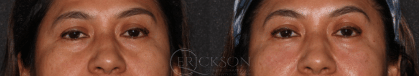 Dermal Fillers Before and After Photo by Dr. Erickson in Chicago, IL