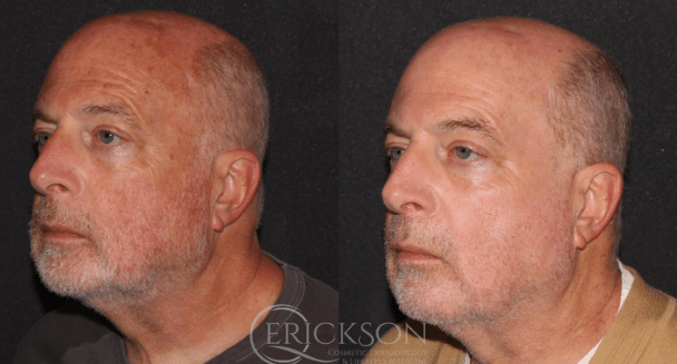 Halo Before and After Photo by Dr. Erickson in Chicago, IL