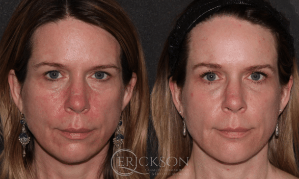 Halo Before and After Photo by Dr. Erickson in Chicago, IL