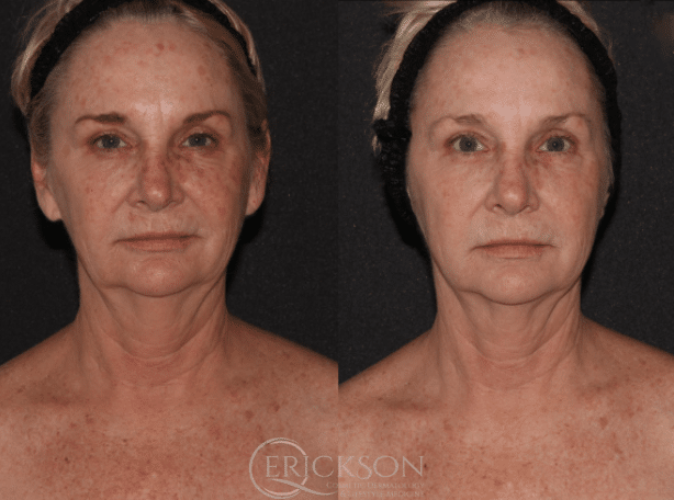 Halo Before and After Photo by Dr. Erickson in Chicago, IL