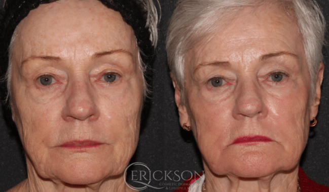 Halo Before and After Photo by Dr. Erickson in Chicago, IL
