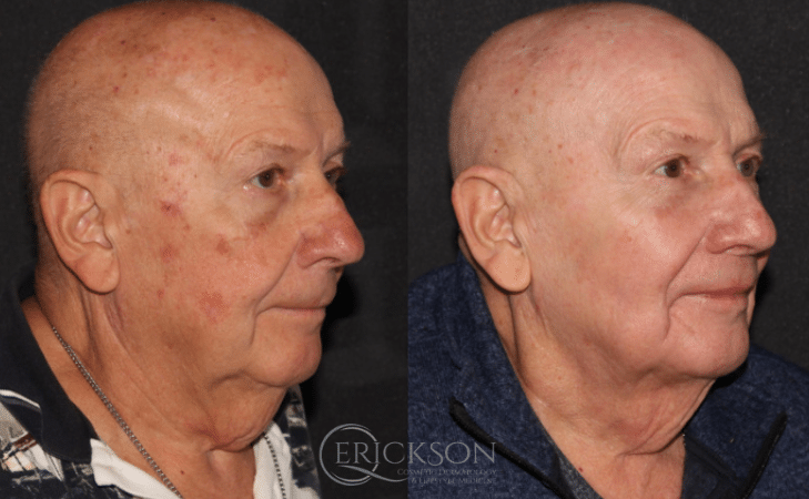 Halo Before and After Photo by Dr. Erickson in Chicago, IL