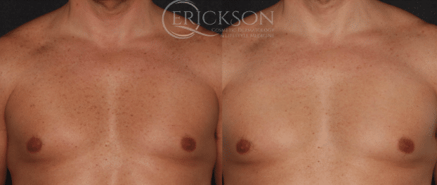 Forever Young BBL Before and After Photo by Dr. Erickson in Chicago, IL