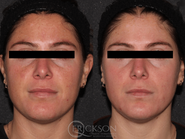 MOXI® Before and After Photo by Dr. Erickson in Chicago, IL