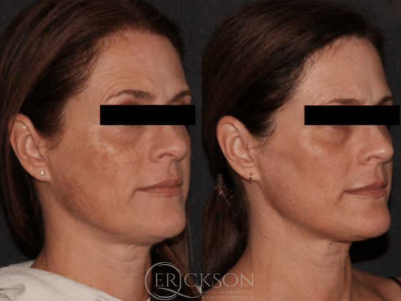 MOXI® Before and After Photo by Dr. Erickson in Chicago, IL