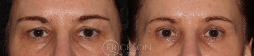 Blepharoplasty Before and After Photo by Dr. Erickson in Chicago, IL