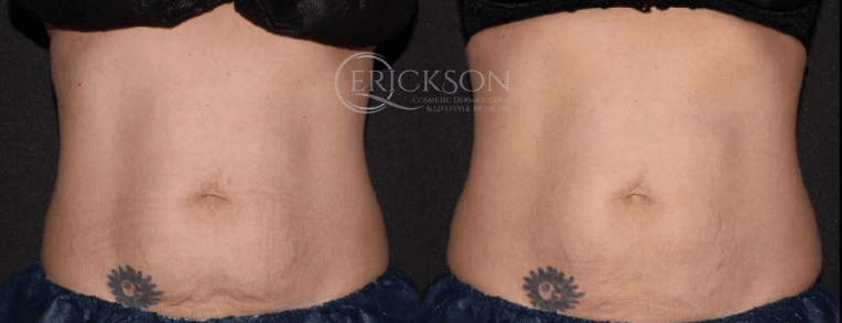 NuEra™ Before and After Photo by Dr. Erickson in Chicago, IL