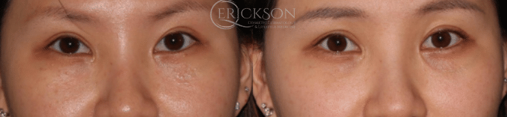 M22 Photofractional ResurFX Before and After Photo by Dr. Erickson in Chicago, IL