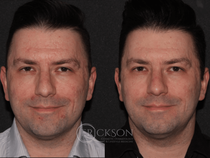 Secret™ RF Before and After Photo by Dr. Erickson in Chicago, IL