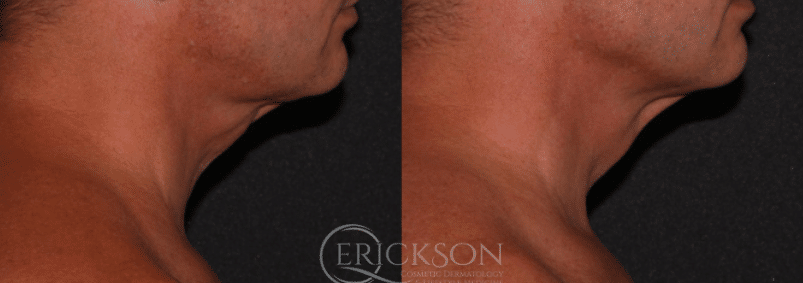 Ultherapy® Before and After Photo by Dr. Erickson in Chicago, IL