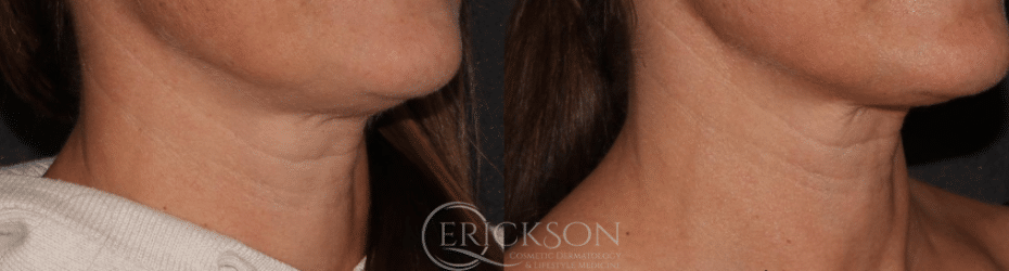 Sofwave™ Before and After Photo by Dr. Erickson in Chicago, IL