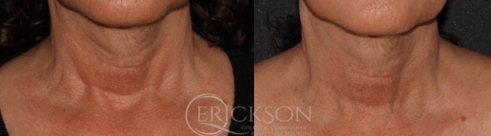 Sofwave™ Before and After Photo by Dr. Erickson in Chicago, IL