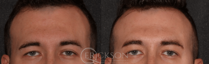 Sofwave™ Before and After Photo by Dr. Erickson in Chicago, IL