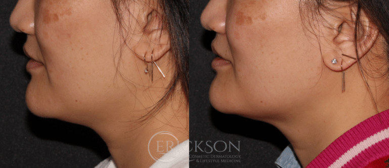 Sofwave™ Before and After Photo by Dr. Erickson in Chicago, IL