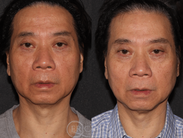 ClearSilk Before and After Photo by Dr. Erickson in Chicago, IL