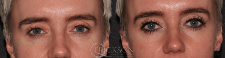 ClearV Before and After Photo by Dr. Erickson in Chicago, IL