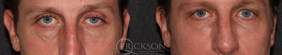 ClearV Before and After Photo by Dr. Erickson in Chicago, IL