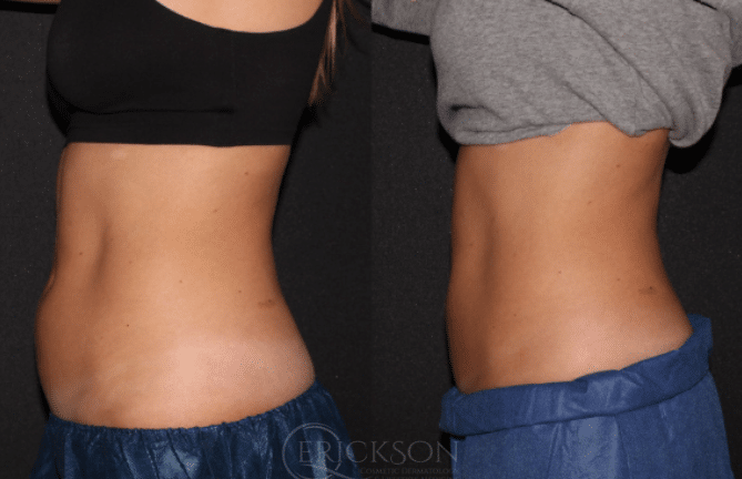 CoolSculpting Before and After Photo by Dr. Erickson in Chicago, IL
