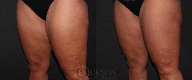 CoolSculpting Before and After Photo by Dr. Erickson in Chicago, IL