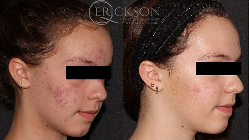 AviClear® Before and After Photo by Dr. Erickson in Chicago IL