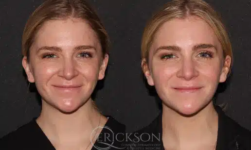 Dermal Fillers Before and After Photo by Dr. Erickson in Chicago, IL