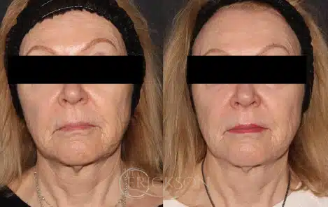 Secret™ RF Before and After Photo by Dr. Erickson in Chicago, IL
