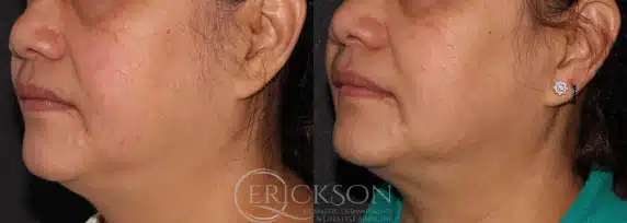 ClearV Before and After Photo by Dr. Erickson in Chicago, IL