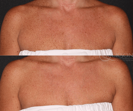 MOXI® Before and After Photo by Dr. Erickson in Chicago, IL