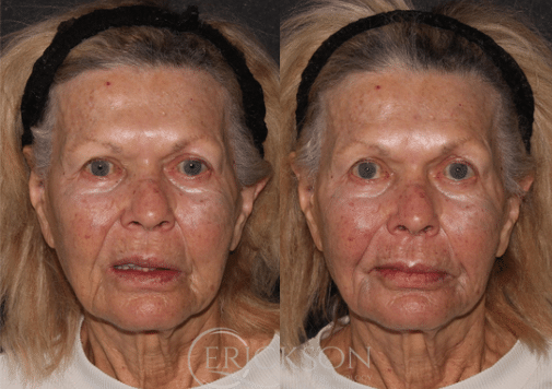 Dermal Fillers Before and After Photo by Dr. Erickson in Chicago, IL