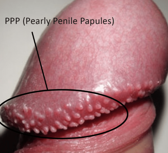 Pearly Penile Papules (PPP) Condition Overview Close-up of pearly penile papules (PPP) before treatment