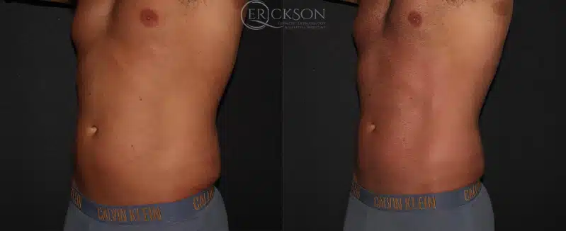 Abs EmSculpt Before and After Photo by Dr. Erickson in Chicago, IL