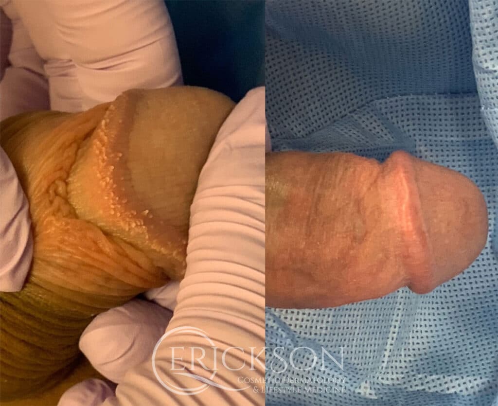 PPP Removal Before and After Photo by Dr. Erickson in Chicago, IL