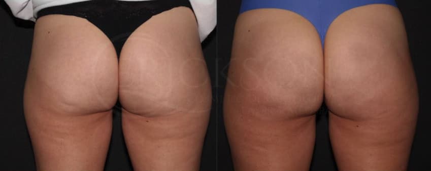 Cellulite/Dimple Release Before and After Photo by Dr. Erickson in Chicago, IL