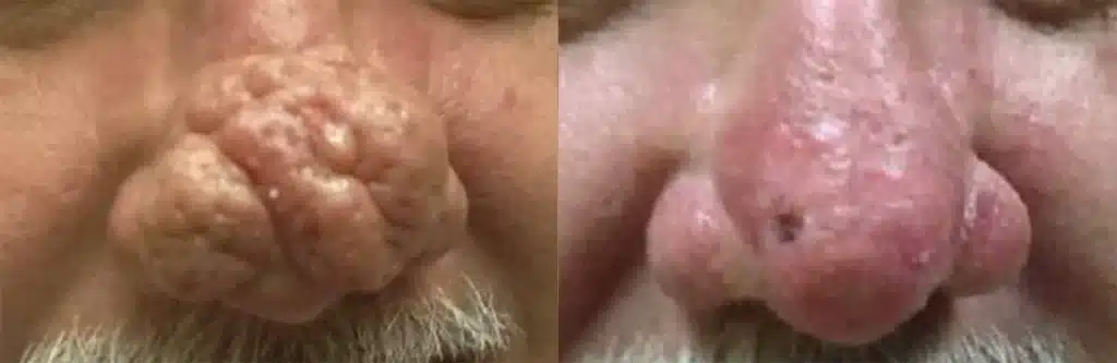 Rhinophyma Before and After Photo by Dr. Erickson in Chicago, IL