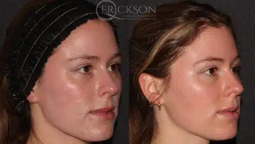 Forever Young BBL & ClearSilk® Before and After Photo by Dr. Erickson in Chicago, IL