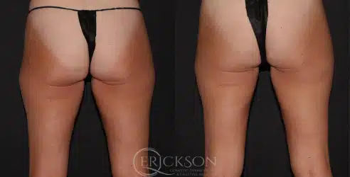 Sofwave™ Before and After Photo by Dr. Erickson in Chicago, IL