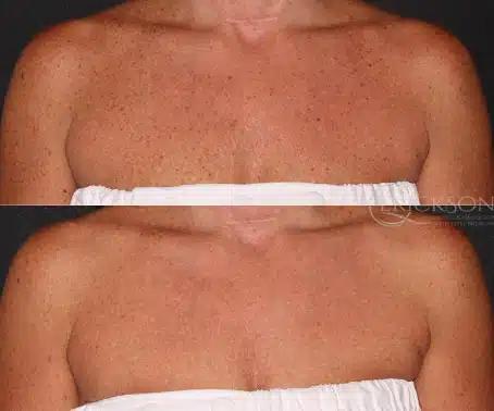 Forever Young BBL Before and After Photo by Dr. Erickson in Chicago, IL