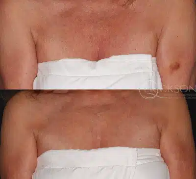 Ultherapy Before and After Photo by Dr. Erickson in Chicago, IL