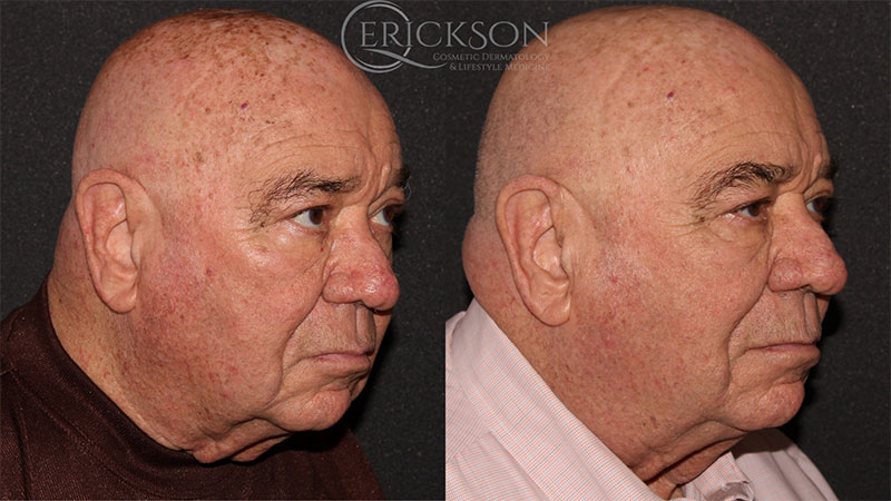 BBL Face Before and After Photo by Dr. Erickson in Chicago, IL