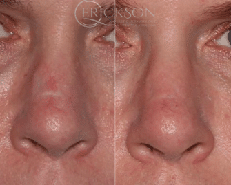 Nasal Contouring Before and After Photo by Dr. Erickson in Chicago, IL