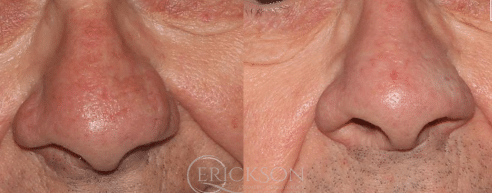 Nasal Contouring Before and After Photo by Dr. Erickson in Chicago, IL