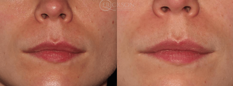 PRP Inejctions Before and After Photo by Dr. Erickson in Chicago, IL