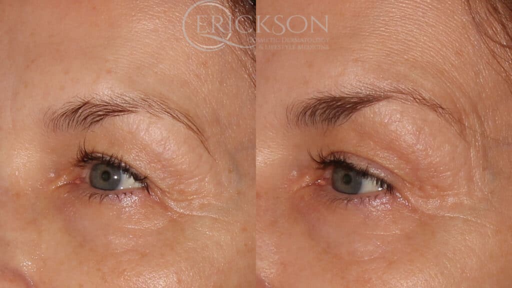 Sofwave™ Before and After Photo by Dr. Erickson in Chicago, IL