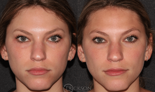 Vampire Facelift Before and After Photo by Dr. Erickson in Chicago, IL