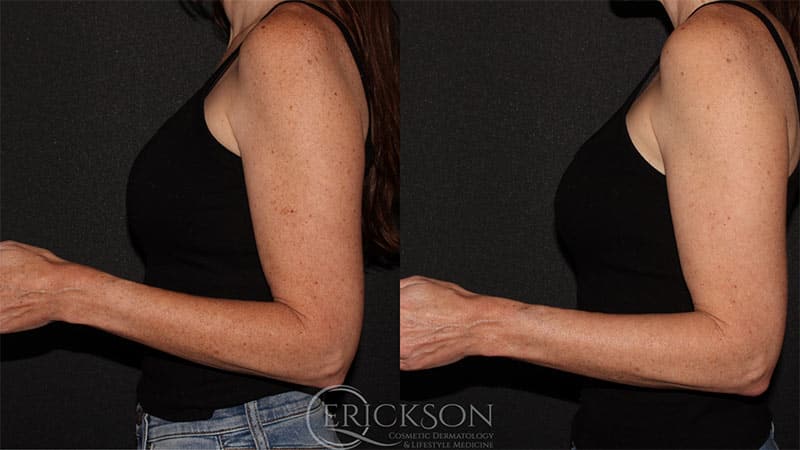 Laser Resurfacing BBL Before and After Photo by Dr. Erickson in Chicago, IL